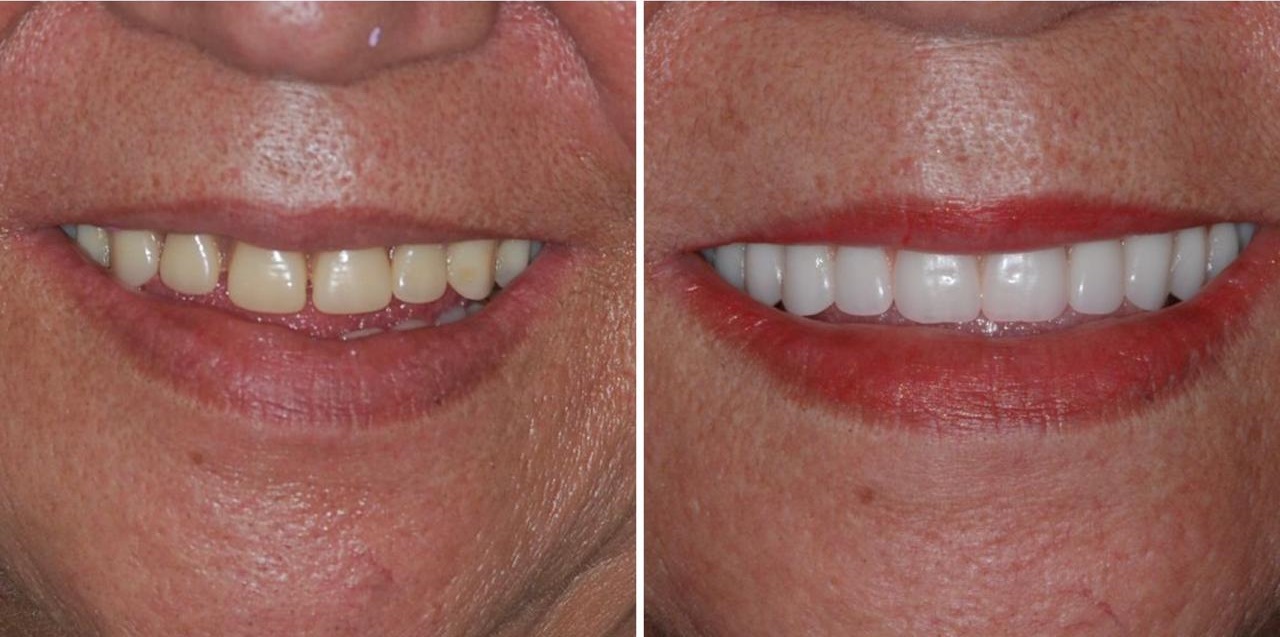 Antes e depois — sorriso